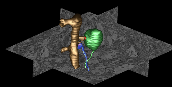 Excess Synuclein Protein in Parkinson's Diease